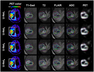 Feasibility of Multimodal MRI-Based Deep Learning Prediction of High Amino Acid Uptake Regions and Survival in Patients With Glioblastoma